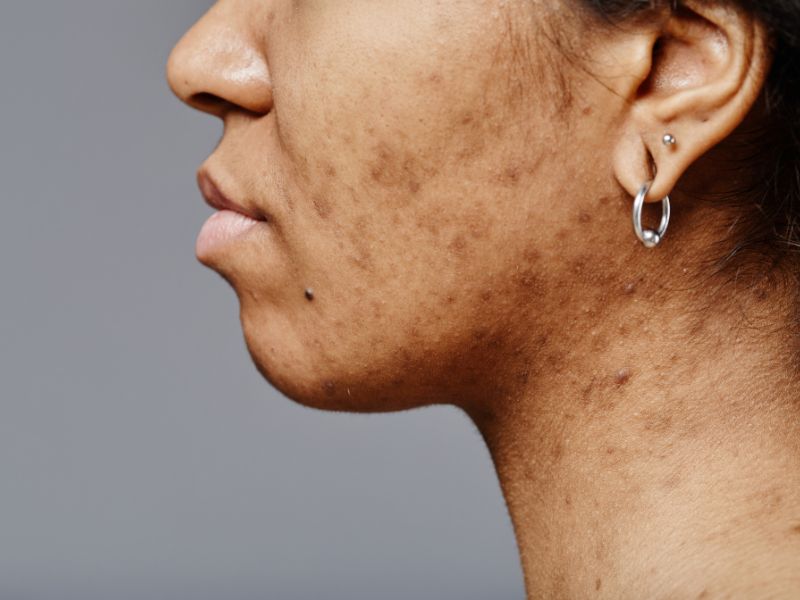 טיפול פיגמנטציה