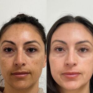 פילינג עמוק