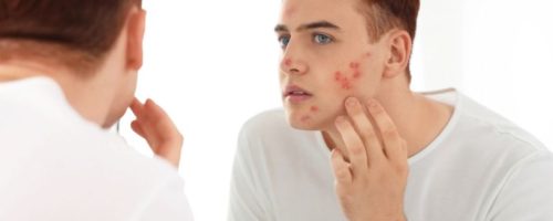 טיפולי אקנה