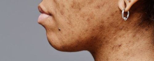 טיפול פיגמנטציה